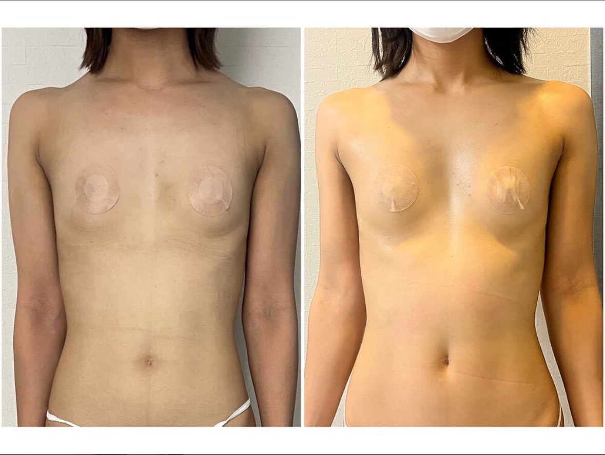 吉川市 NR機器導入 立体バスト形成専門ケア